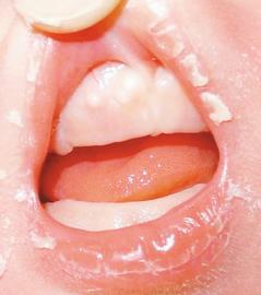 寶寶口腔裡的小白點 上顎中線及牙齦上，一粒粒小白點是正常現象。 圖／張弘洋醫師提供