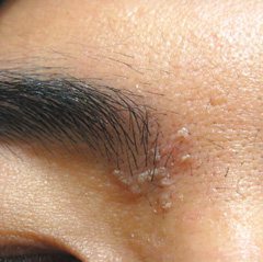 脂漏型皮膚炎患者易在眉心，或T字部位形成黃白色皮塊。 圖／王致統醫師提供