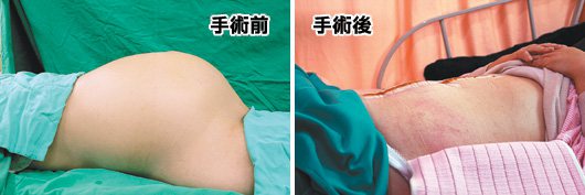 手術前手術後59歲婦人腹痛解尿困難，就醫檢查才知是10公斤重的卵巢腫瘤（左），手術後已經康復（右）。 圖／聖馬爾定醫院提供