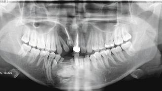 X光檢查發現，白色陰影處有多顆牙齒，手術取出竟有30多顆。 圖／郭峻良醫師提供