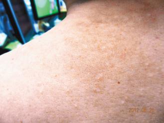 皮膚出現棕色小斑還夾雜白色斑點，是汗斑典型症狀。 圖／施朝仁醫師提供非報系