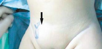 女嬰腹股溝上方有硬塊鼓起，是疝氣明顯症狀。 圖╱林建華醫師提供