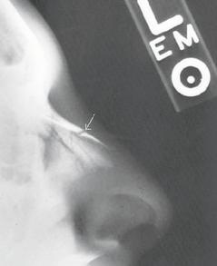 圖中箭頭所指為鼻骨斷裂處。 圖／陳景中醫師提供
