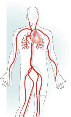 冠狀動脈由主動脈幹底部分出兩邊血管，分別為左主幹及右冠狀動脈，左主幹再分為左前降支與左迴旋支，以及其餘細小的分支，共同供給心肌細胞血液。 圖／曾隆明繪製