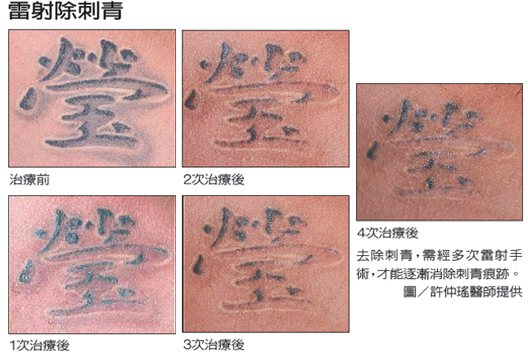 去除刺青，需經多次雷射手術，才能逐漸消除刺青痕跡。 圖／許仲瑤醫師提供