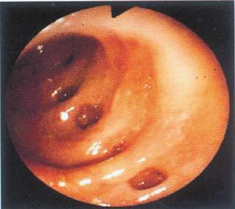 大腸憩室指大腸表層凹陷造成囊狀結構，主要是腸壁肌肉層弱化，壓力增加，於是大腸壁突出，造成憩室。 圖／麥振銘醫師提供