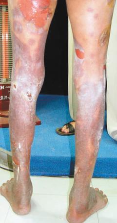罹患固定性藥物疹患者，下肢皮膚看起來像嚴重的燒燙傷。 圖／成大醫院提供