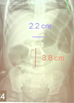 一歲女童因為對牛奶過敏，原本細小的腸道被撐大，透過X光檢查，可以看到結腸的直徑約3.8公分。記者修瑞瑩／翻攝