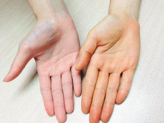 女大生長期吃大量蔬果，罹患黃膚症，手掌明顯變黃（右）。 圖／徐嘉琪醫師提供