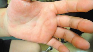 典型汗皰疹看起來像一顆顆細緻晶瑩的小水珠，出現在手指頭或腳趾頭側邊。 圖／邱足滿醫師提供