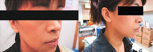 陳小姐經過治療，臉上紅斑（左圖）明顯消退，恢復正常膚質（右圖）。 圖／大甲李綜合醫院提供