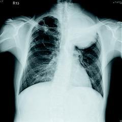 患者肺癌腫瘤長在左上肺葉，10平方公分的巨大腫瘤破壞肋骨，並且往後上背長出。因此患者左後背疼痛，醫師用手即可摸到一大塊如拳頭大的軟組織。 郭忠和醫師/提供