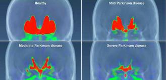林口長庚研究發現，正子影像AV133可診斷帕金森症，正常人腦中的多巴胺細胞分泌(上圖左)，隨著帕金森症輕度(上圖右)、中度(下圖左)、重度(下圖右)越來越凋亡。
 林口長庚/提供