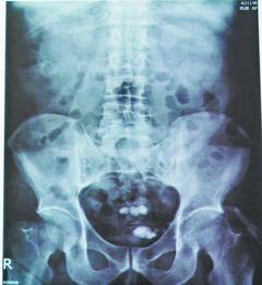<br>黃姓男子因接受腹腔鏡疝氣手術，引發膀胱結石，X光片當中可以看到膀胱內有多顆結石。</br>
記者修瑞瑩／翻攝