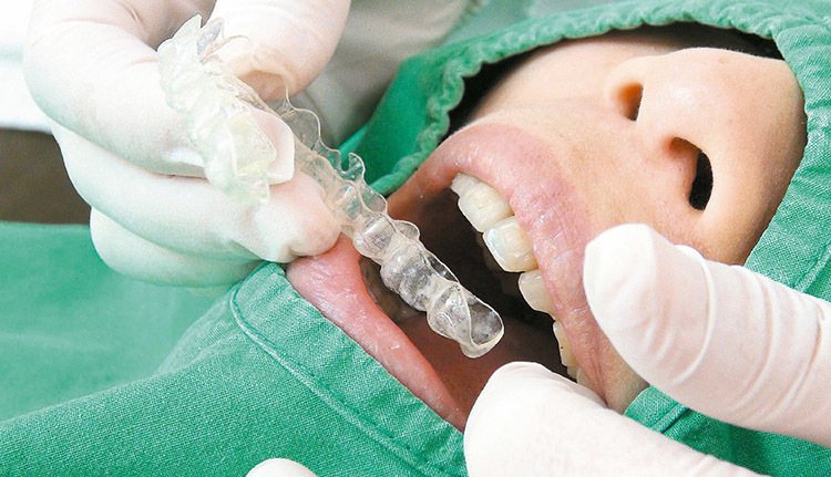 用隱形牙套矯正牙齒的患者漸多。