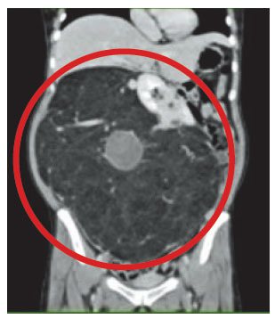 該患者腹腔內塞滿腫瘤(紅圈處)，原本右側腎臟被擠至左邊，開刀後右腎回到原位，腎功能逐漸恢復。