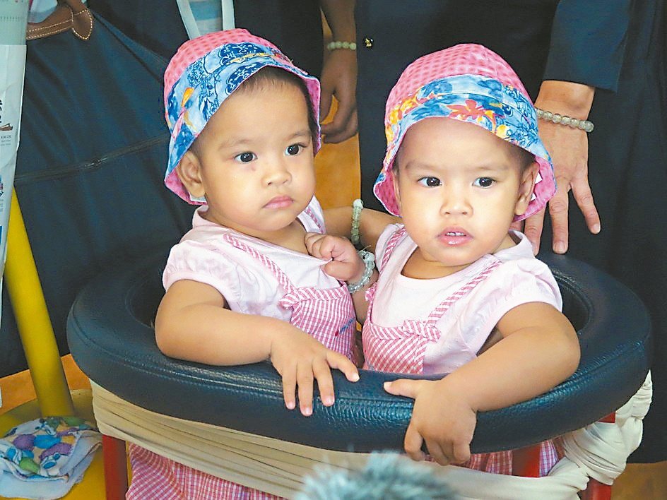 菲律賓的連體嬰珍妮與潔妮，在花蓮慈濟醫院接受分割手術，展開獨立的人生。