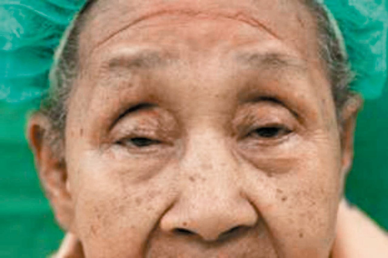 78歲曾張女士因退化性眼瞼下垂，眼睛一度只能張開3至4毫米。