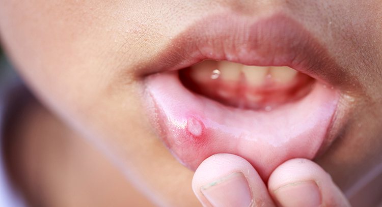 嘴破有時是癌症的前兆。