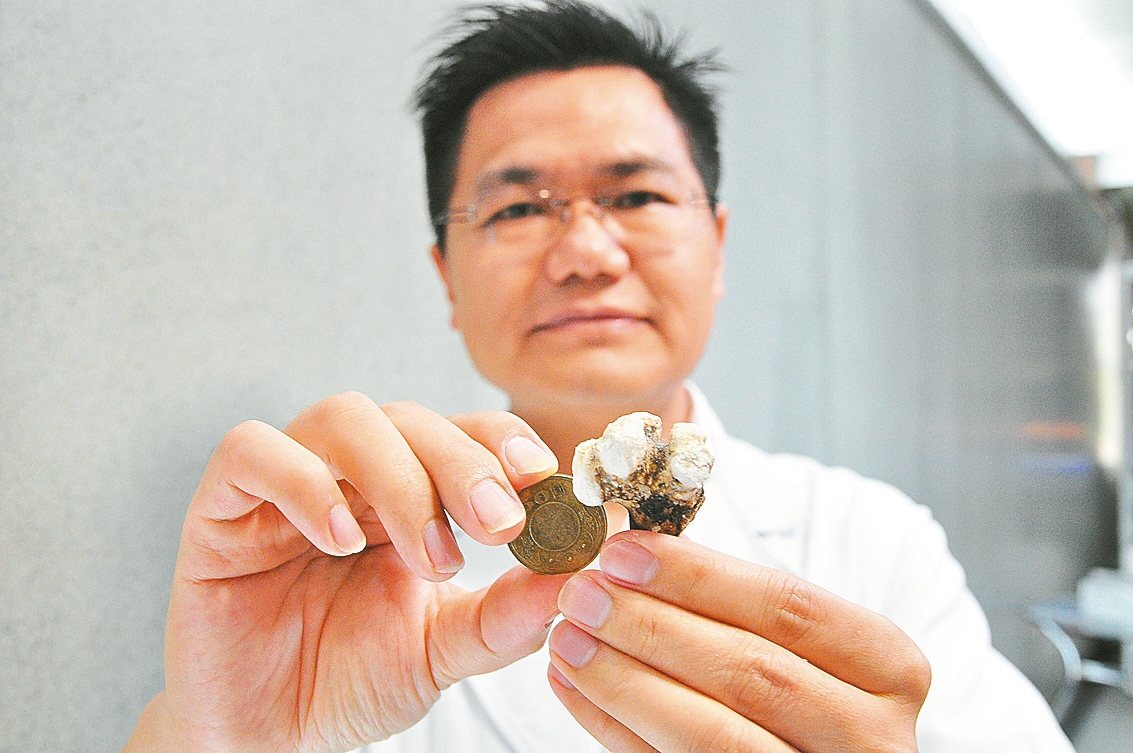 汪男的腎結石「養」3年，體積比50元硬幣大，形狀呈現不規則鹿角狀。