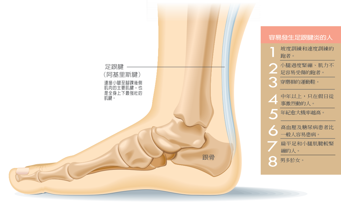 「阿基里斯肌腱炎」也就是俗稱的足跟腱炎，隨著路跑風氣的盛行，也成為跑者常見的運動傷害。