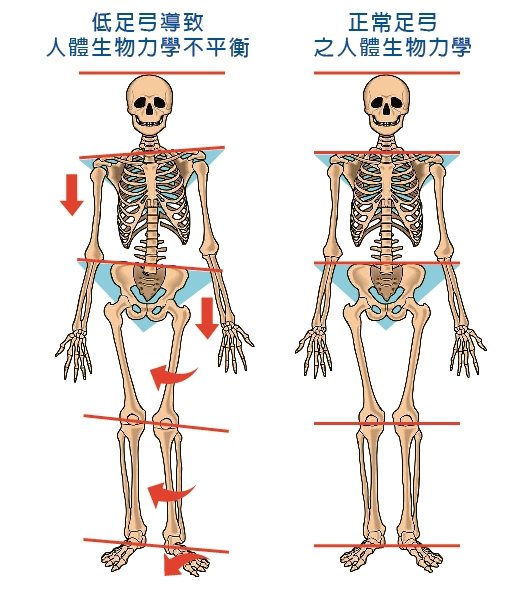 左為足弓過低導致足體內旋，使脛骨、膝蓋、股骨和髖關節連帶往內轉，同側骨盆與對側肩膀則歪斜向下。