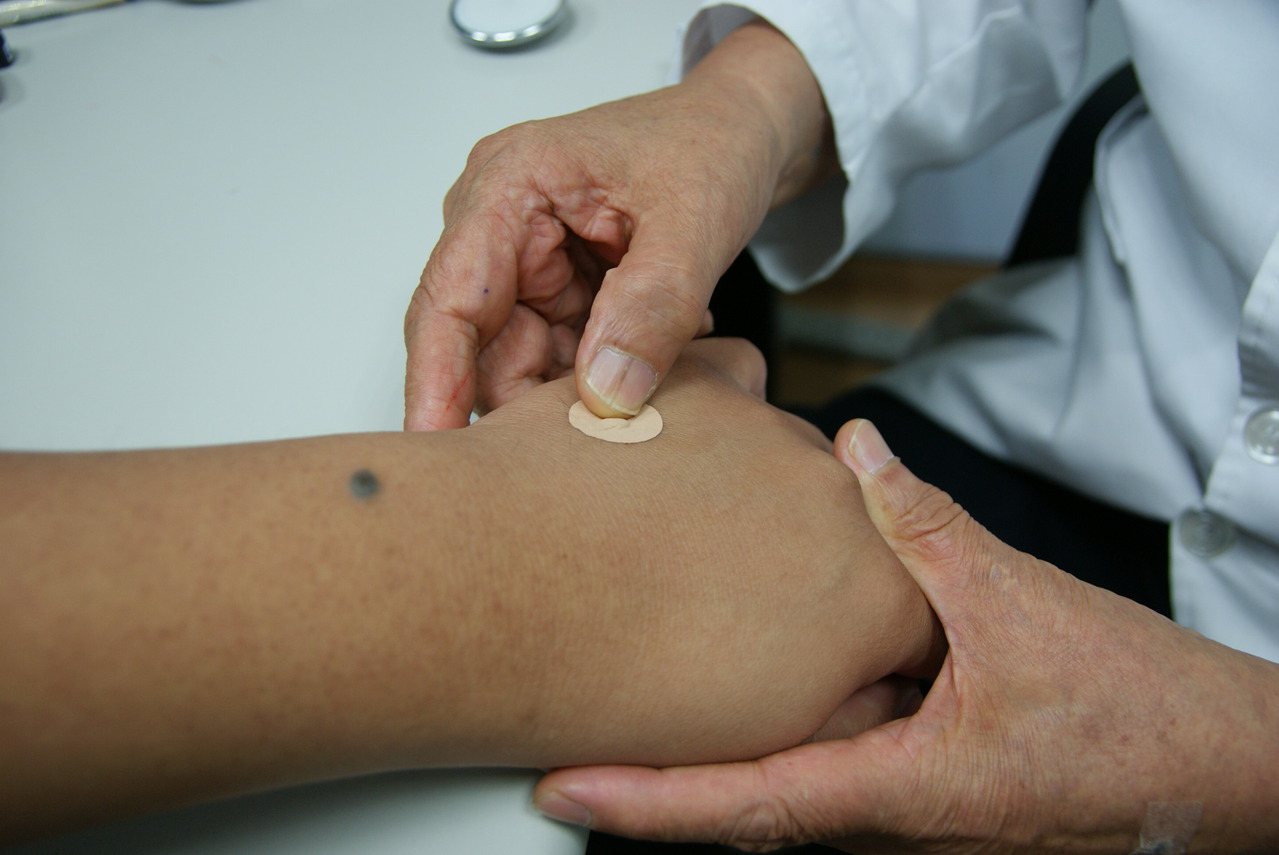 吳輝雄磁貼在腰腿穴，研究下背痛磁力療法。圖／衛生福利部苗栗醫院提供