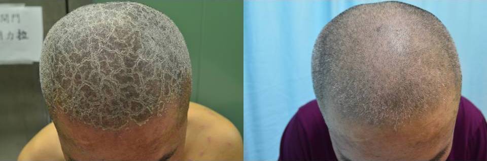 乾癬頭皮病灶治療前（左）與治療後（右），硬殼似的乾癬斑塊獲得改善。圖／新竹馬偕醫院提供