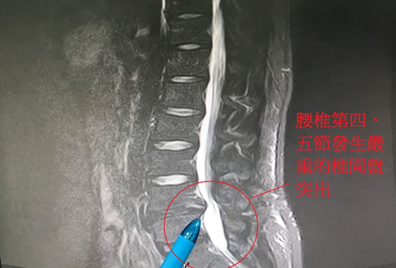 陳姓病患經檢查發現是腰椎第四、五節發生嚴重的椎間盤突出。圖／醫師謝昌昇提供