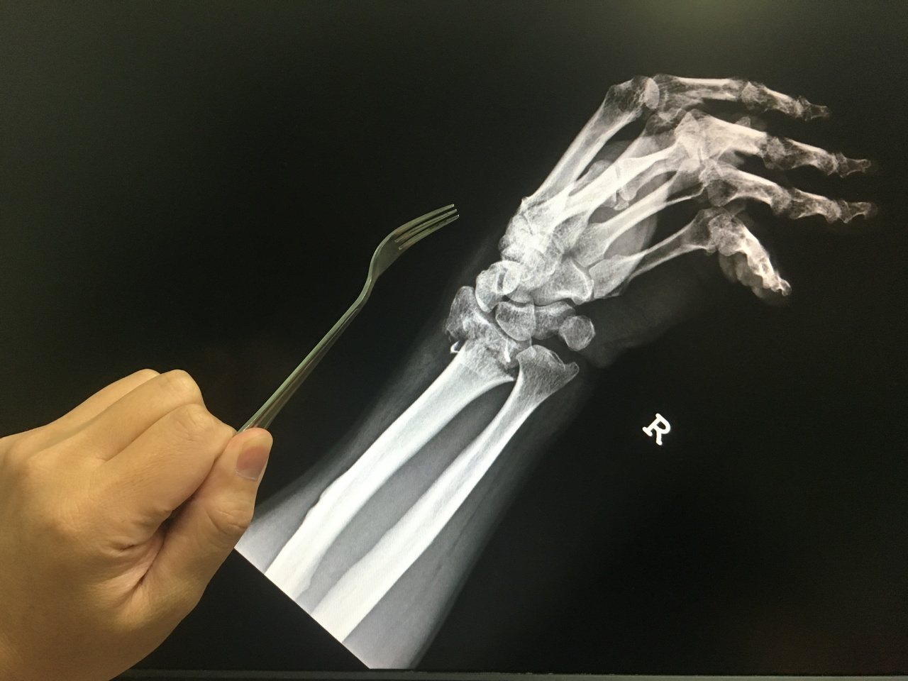 腕部骨折X光片中的橈骨和尺骨斷裂移位，原該平行銜接的腕部卻像「餐叉」般彎曲。圖／南投醫院提供