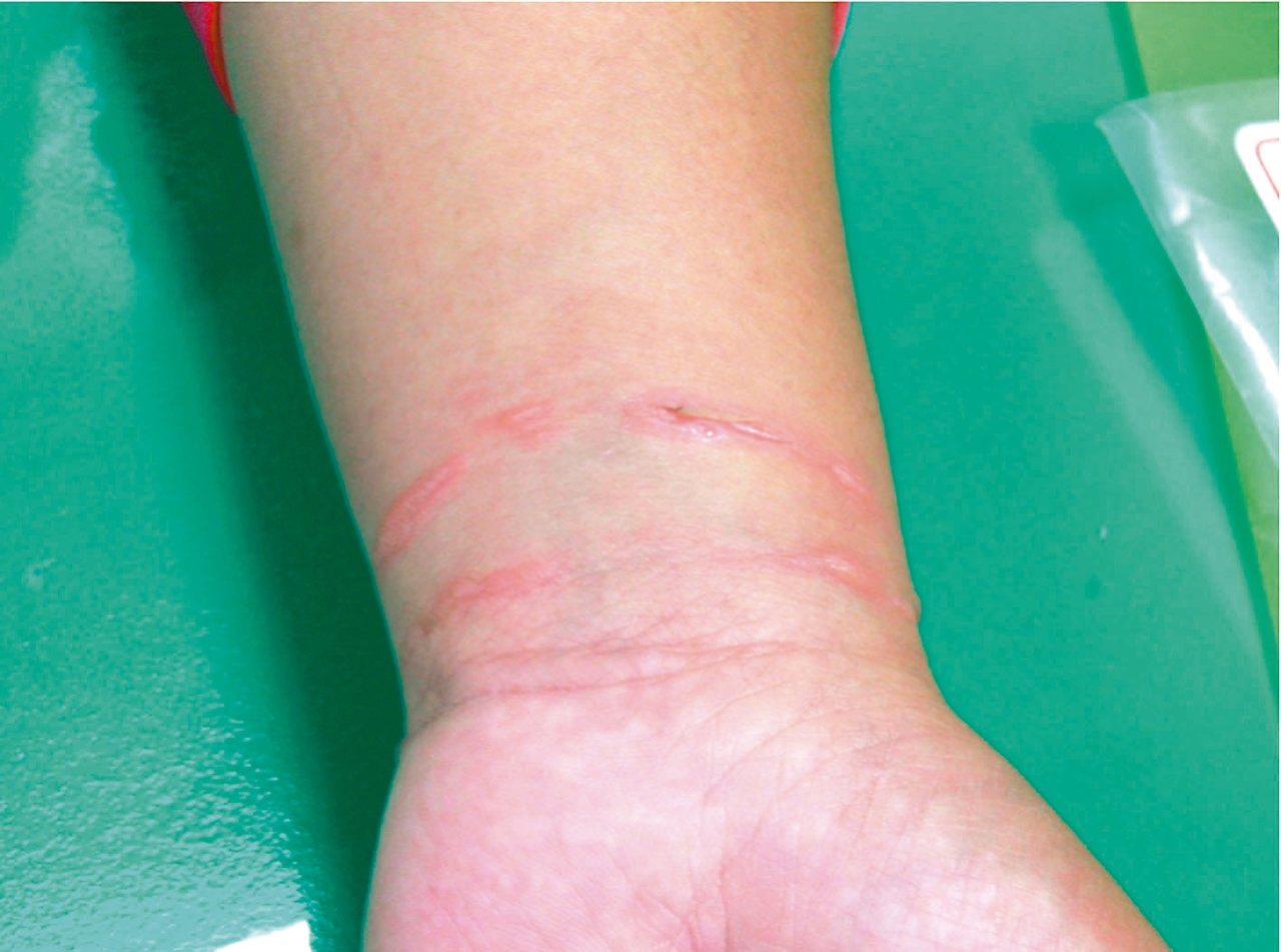 遺傳性血管水腫病患者手部腫脹到撐破皮膚，常讓人誤以為是割腕所致。