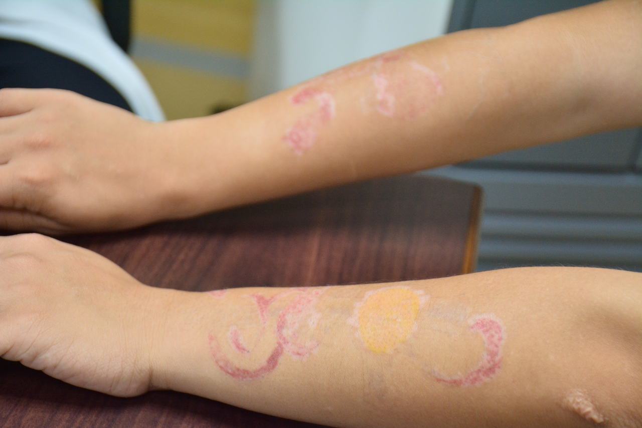 陳姓女學生雙手前臂刺青經過「皮秒雷射」7次去除後，顏色已經淡了。記者吳淑玲／攝影