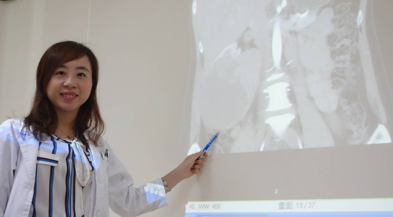 泌尿科醫師李香瑩說，該名女性患者的腎細胞腫瘤大至12公分，從後腹向前延伸，還從右下腹部突出，最後以腹腔鏡微創手術切除。記者蔡容喬／攝影