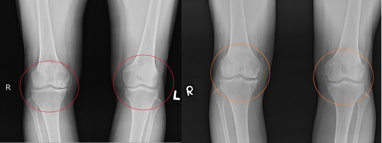 婦人嚴重雙膝關節退化，還有多處骨刺（左圖），經PRP與增生注射療法後（右圖），關節間隙變大減少磨損，退化及疼痛程度都改善。圖／活力得中山脊椎外科醫院提供