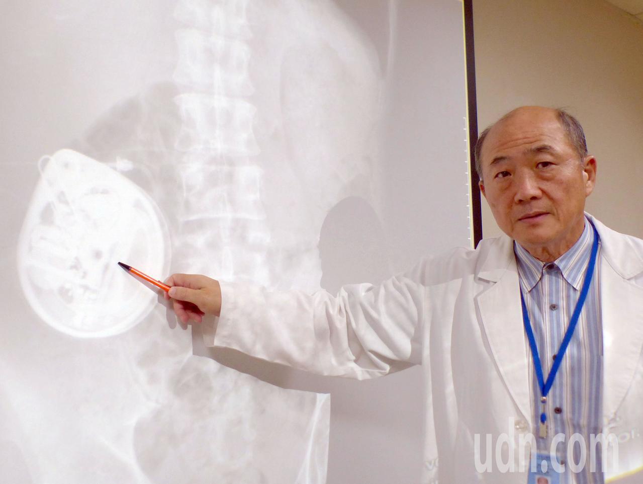 醫師劉榮東說明，林姓病患在腹部皮下植入幫浦，透過導管分次將藥物注入脊髓腔內，直接作用在中樞神經上。記者趙容萱／攝影