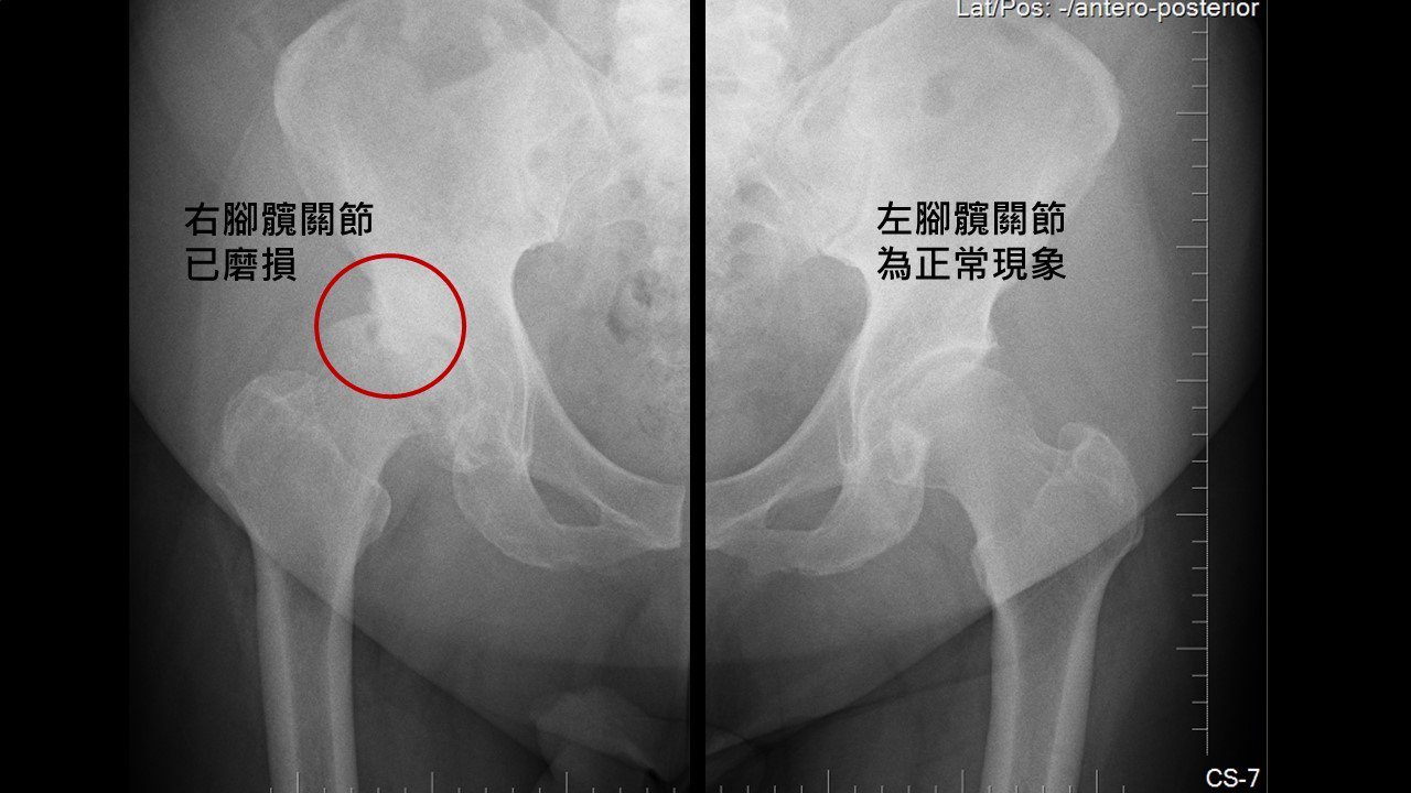 透過X光圖，可見左側的右髖軟骨磨損。圖／長安醫院提供