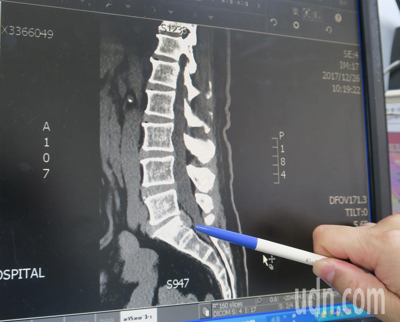 彰化醫院神經外科主任趙紹清說69歲楊先生脊椎已退化，加上突來的外力才會造成椎間盤破裂。記者林宛諭／攝影