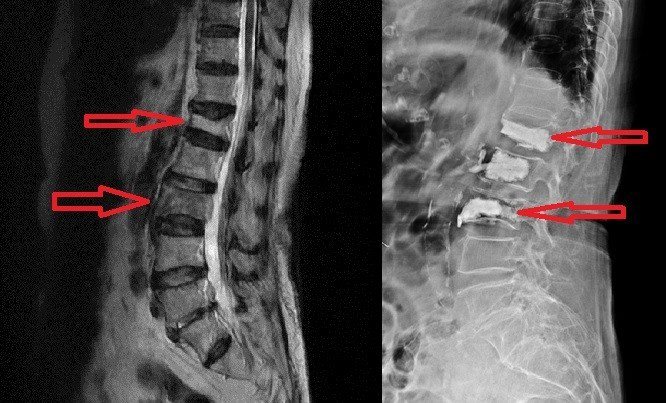 近百歲婦人跌一跤造成腰椎第一及第三節壓迫性骨折（左）在接受椎體成形術後（右）脊椎穩定性增強且馬上不痛可以站立。 圖／業者提供