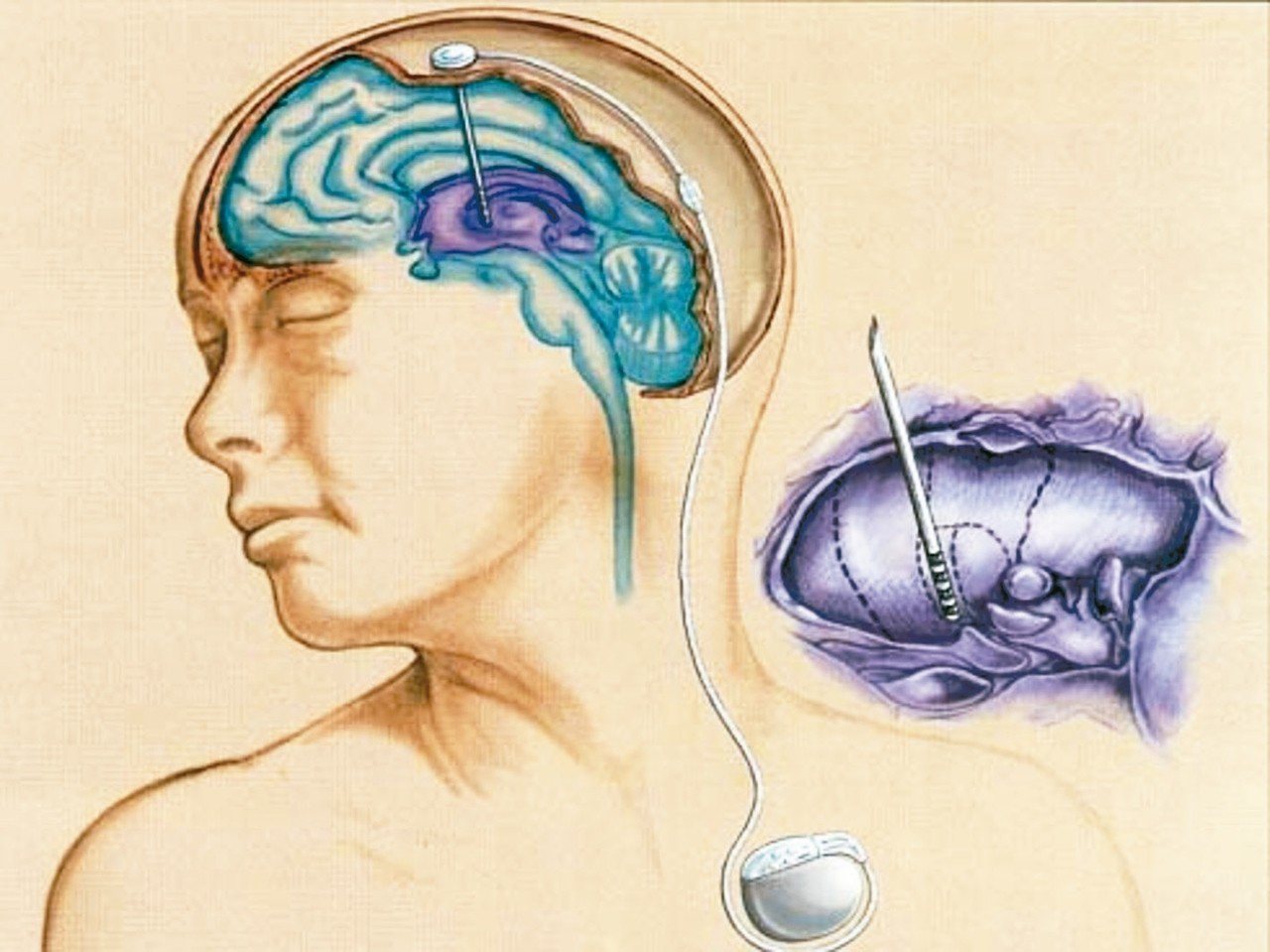 目前醫學界採用深腦電刺激手術來治療合併有藥效波動的中重度巴金森症患者（圖），利用深腦電極裝置（又稱晶片）植入患者腦部的神經核，並將電極連接胸前的電刺激器，術後醫師可利用此一深腦電極，注入微小的電流，來調節控制異常的大腦運動功能，如此可大幅取代患者高度依賴多巴胺藥物來改善運動症狀的情況。