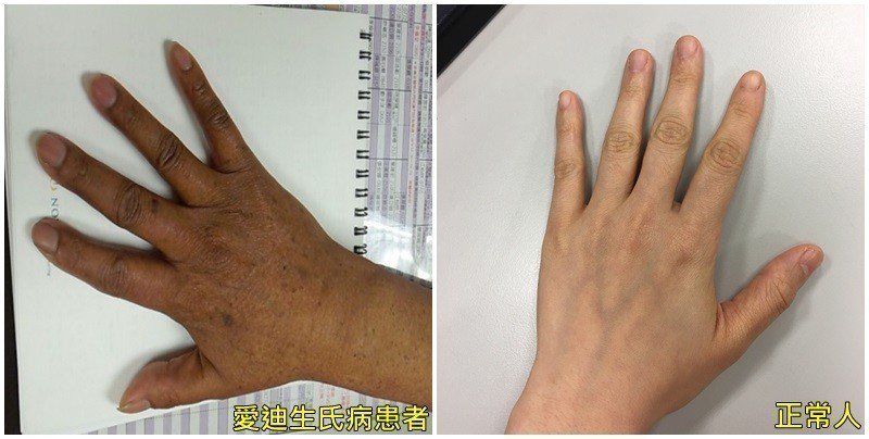 罹有「愛迪生氏病」的患者與正常手的顏色對比，要明顯黑了一些。圖／