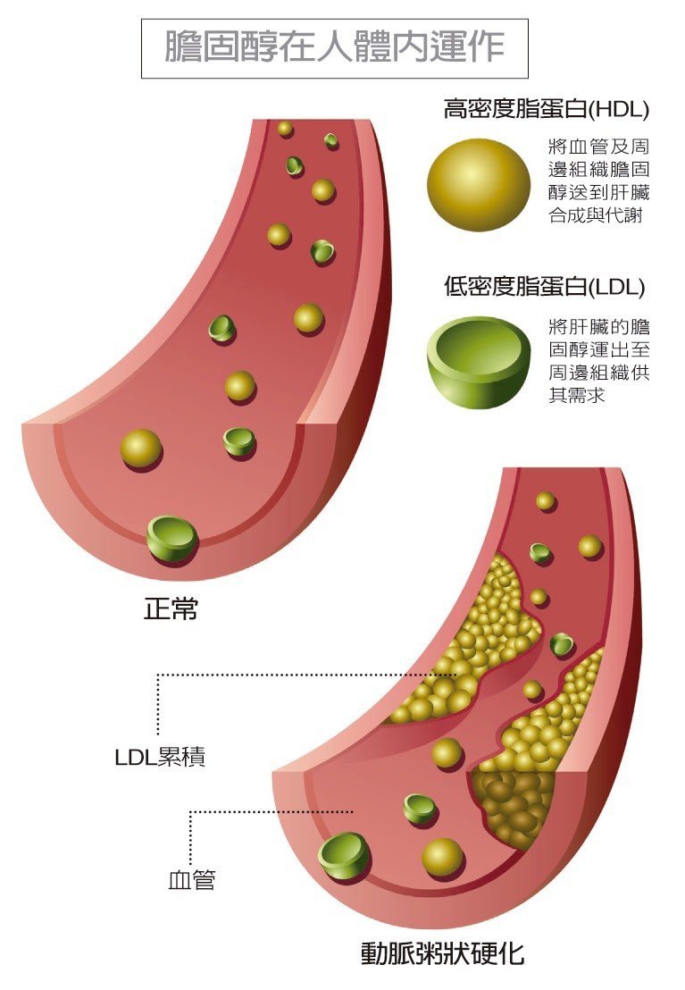 HDL和LDL各司其職，缺一不可。但LDL可能經氧化作用被巨噬細胞吞食，此時運送的膽固醇將掉落、沉積血管壁，進而形成動脈粥狀硬化。