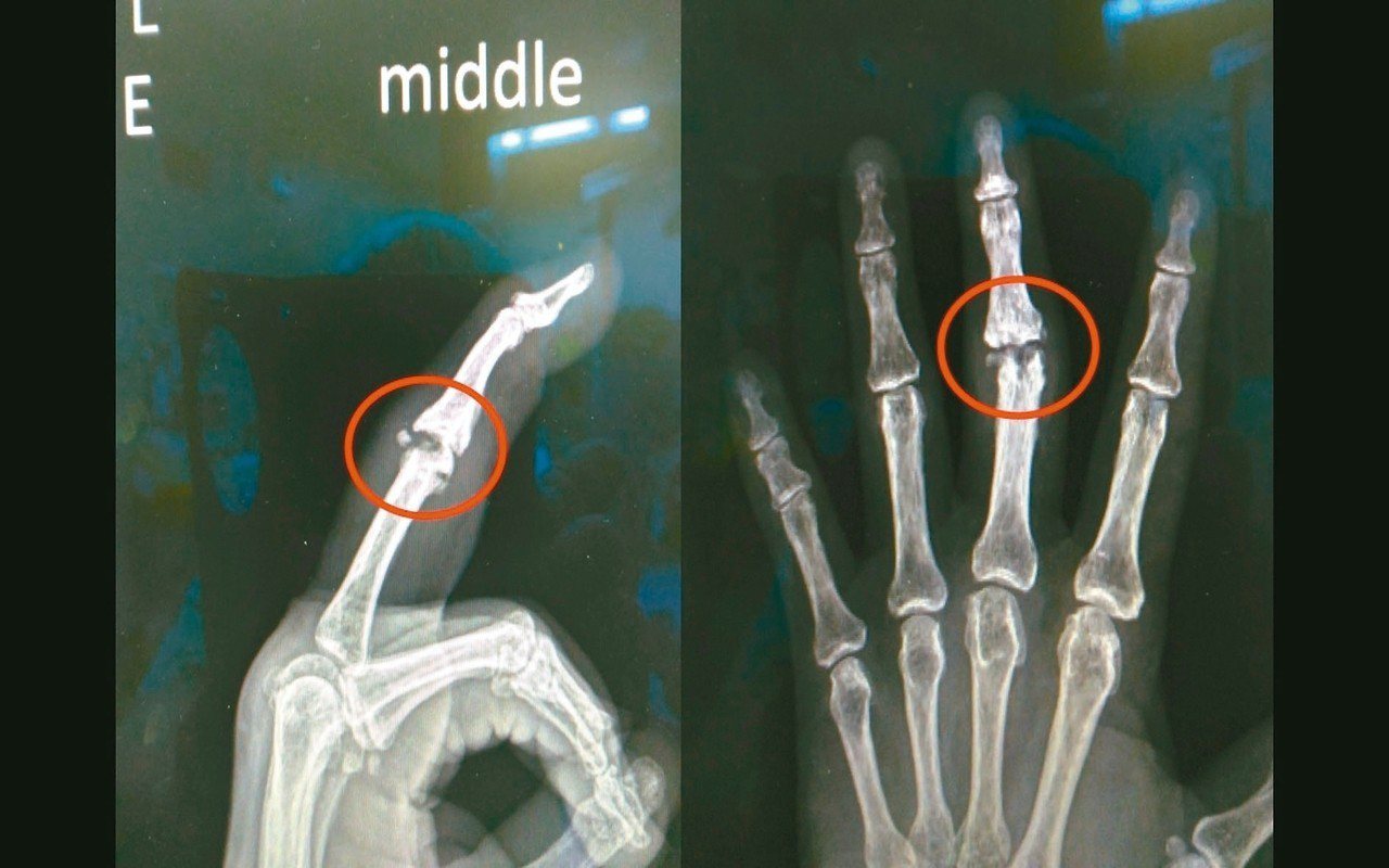從X光片可以看到手指近端指關節退化。