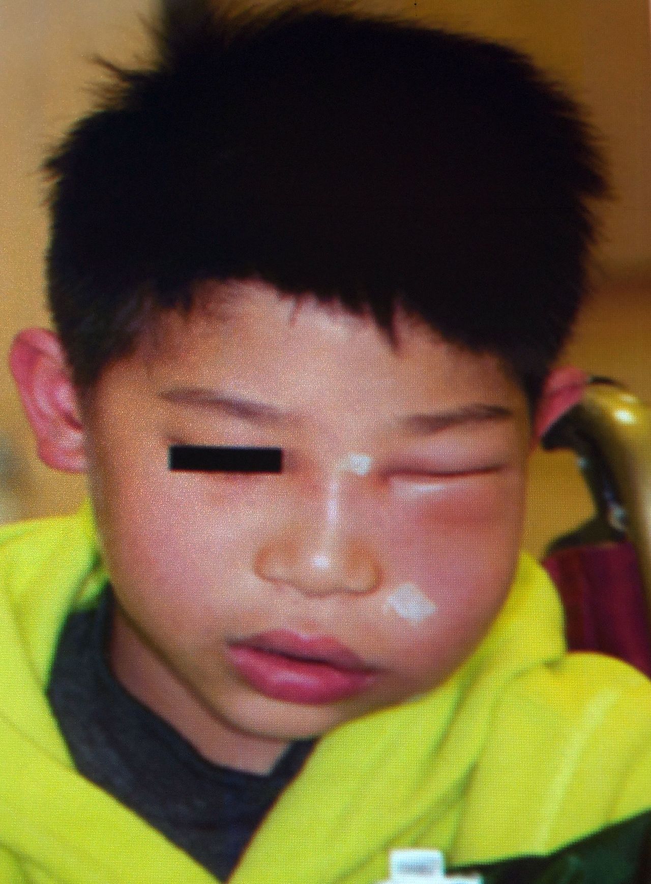 醫師洪仲銳說明，5歲黃小弟左臉頰腫得像「麵龜」，可能與孩子刷牙不確定有關，建議家長別放任讓孩子自己刷牙不管。圖／洪仲銳提供