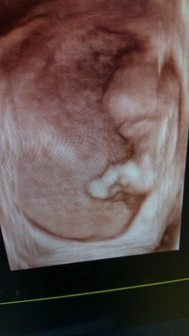 桃園市一名陳小姐卵巢巧克力囊腫術後1個月順利懷孕，上週產檢透過3D超音波，看到活力充沛、手足舞蹈的金豬寶寶。圖／衛生福利部桃園醫院提供