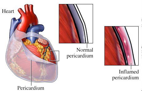 「心包膜填塞」是指包圍心臟的雙層膜囊累積大量液體，並且壓迫心臟的情形。圖／翻攝自三軍總醫院網站