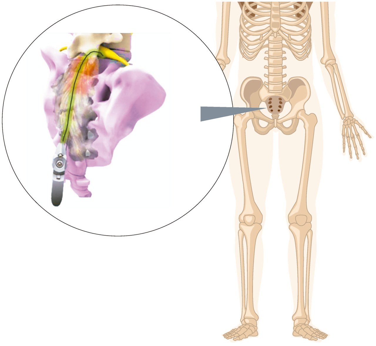 「脊內導管」從尾椎孔將進入「硬脊膜上腔」中，可以注射藥物及分離沾黏組織。