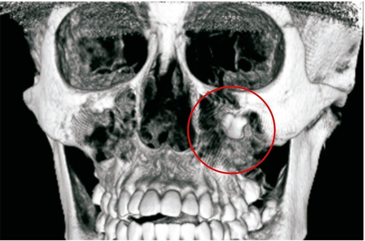 嚕嚕的智齒非常深，長在左眼眶下緣，巨大的囊腫佔據了整個上顎鼻竇。照片／彰基提供