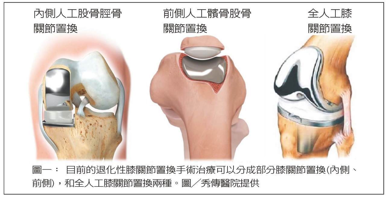 圖一： 目前的退化性膝關節置換手術治療可以分成部分膝關節置換(內側、前側)，和全人工膝關節置換兩種。