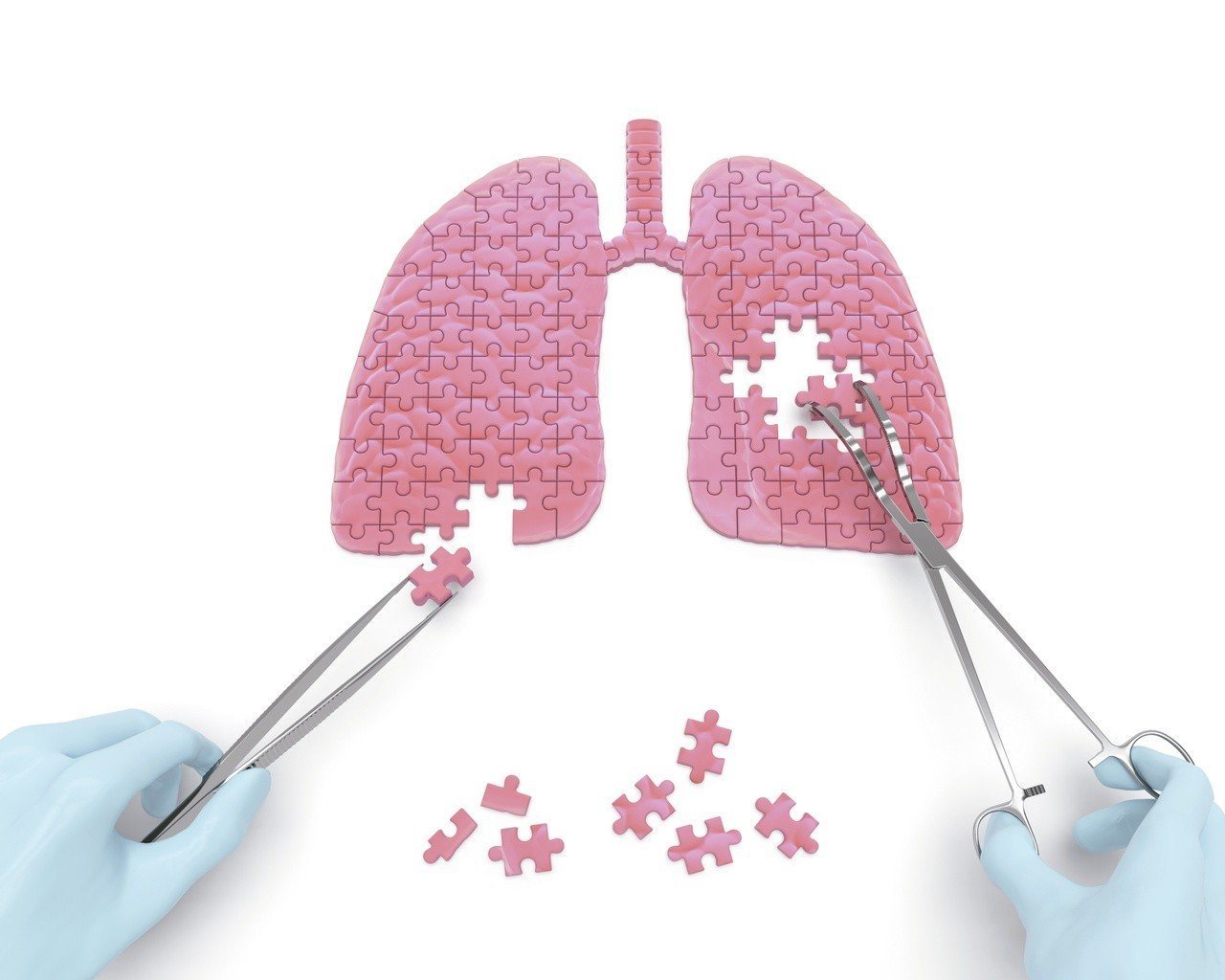 醫師提醒，國內肺癌患者逐年增加，建議高危險群定期接受檢查。

圖／123RF