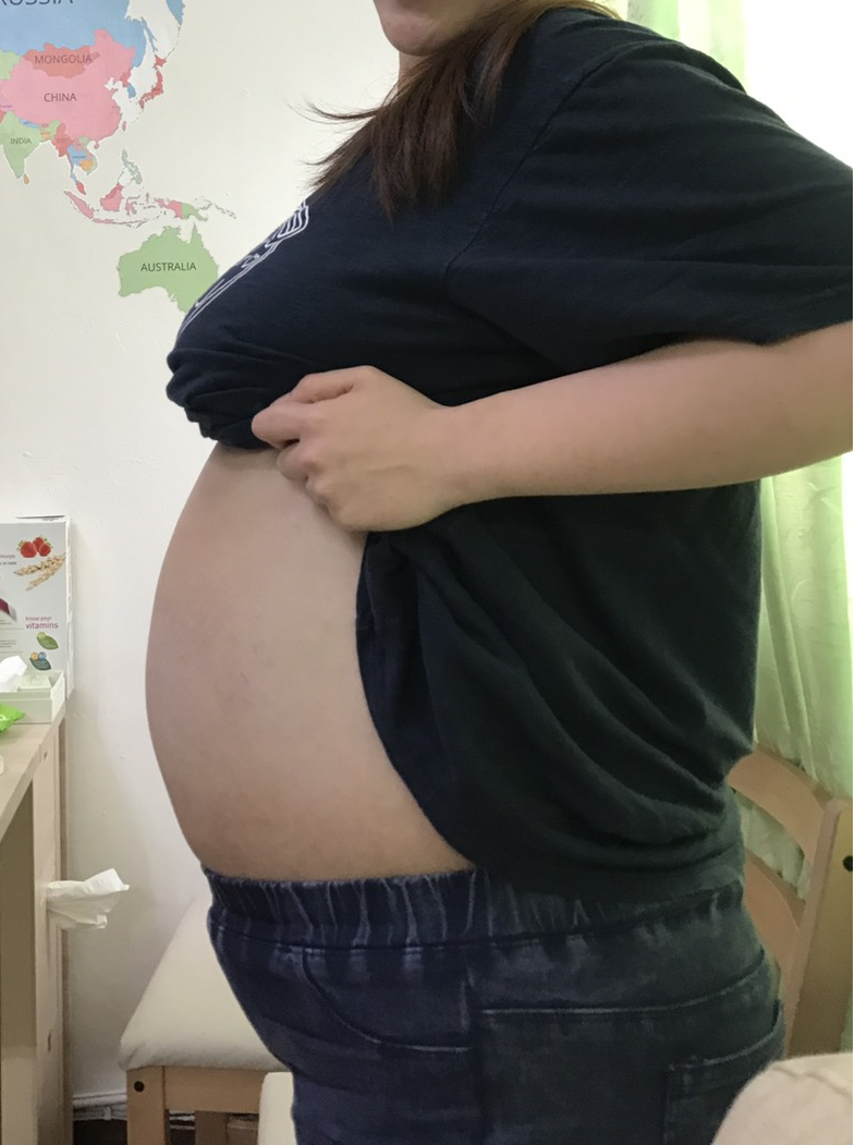 一名28歲輕熟女減肥卻發現只有腹部沒瘦，就醫檢查後才知道，輸卵管長了40公分、重達16公斤的大水瘤。圖為該名患者術前照片。圖／國泰醫院提供